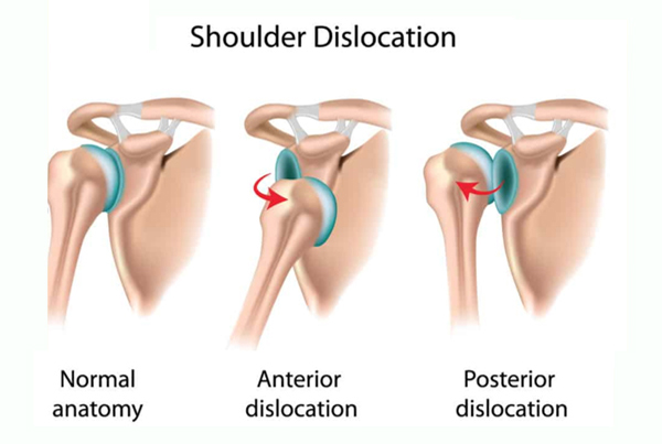 Shoulder Dislocation