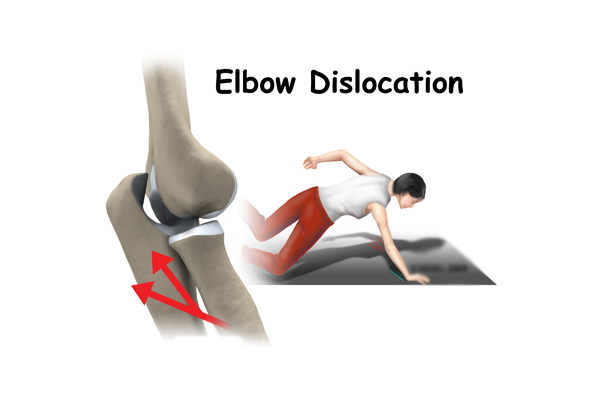 Elbow Dislocation