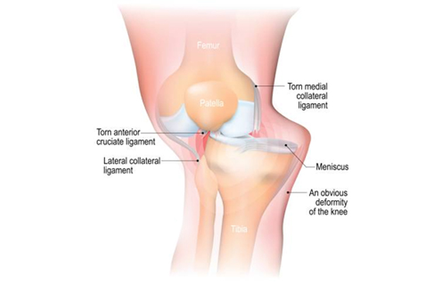 Knee Dislocation