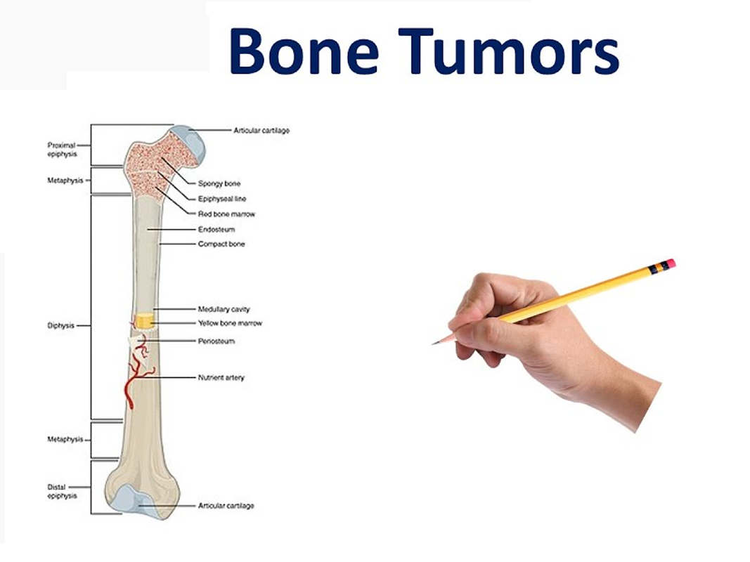Bone Tumors