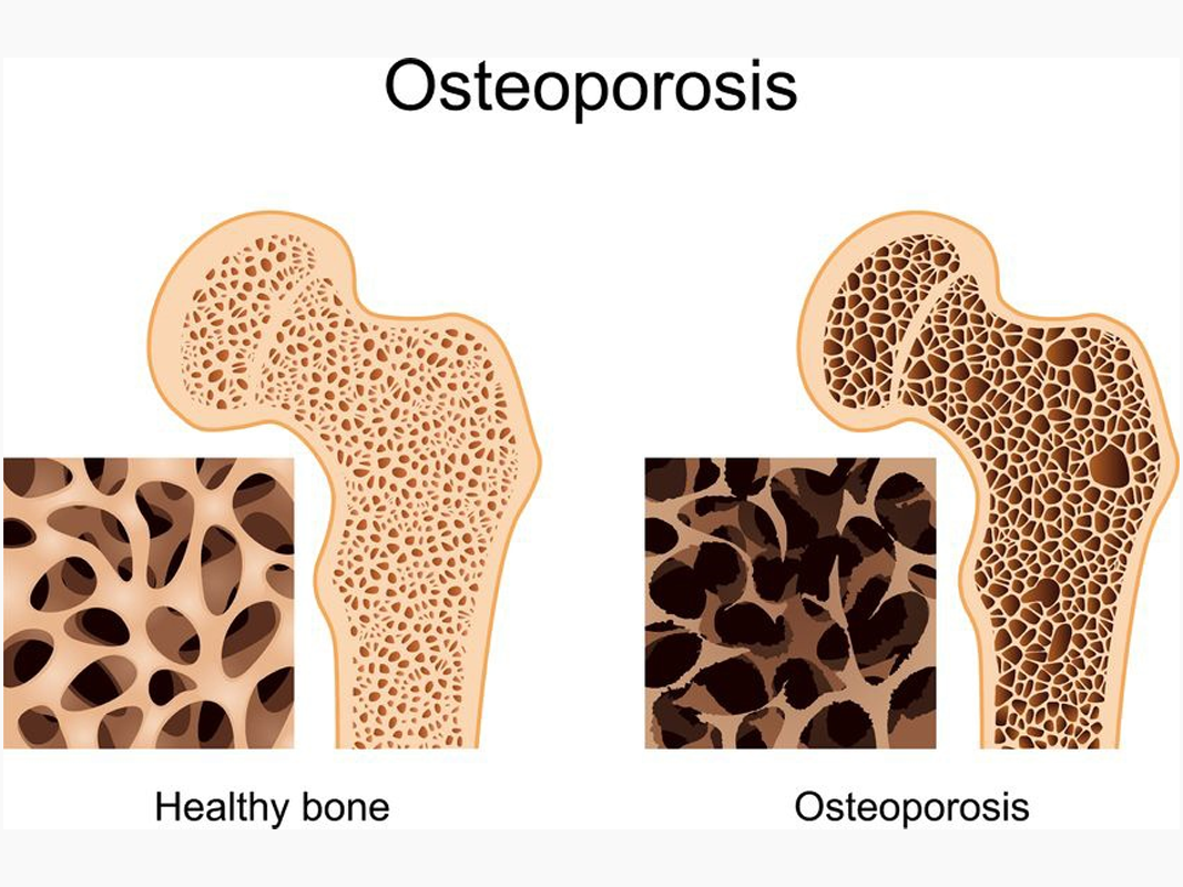 Osteoporosis