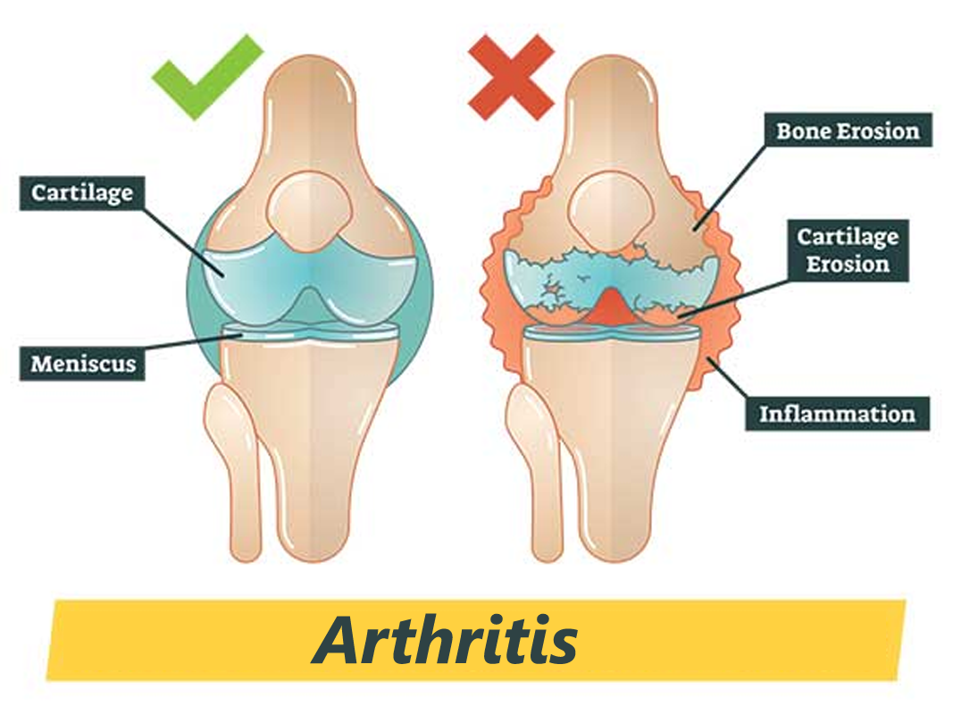 Arthritis