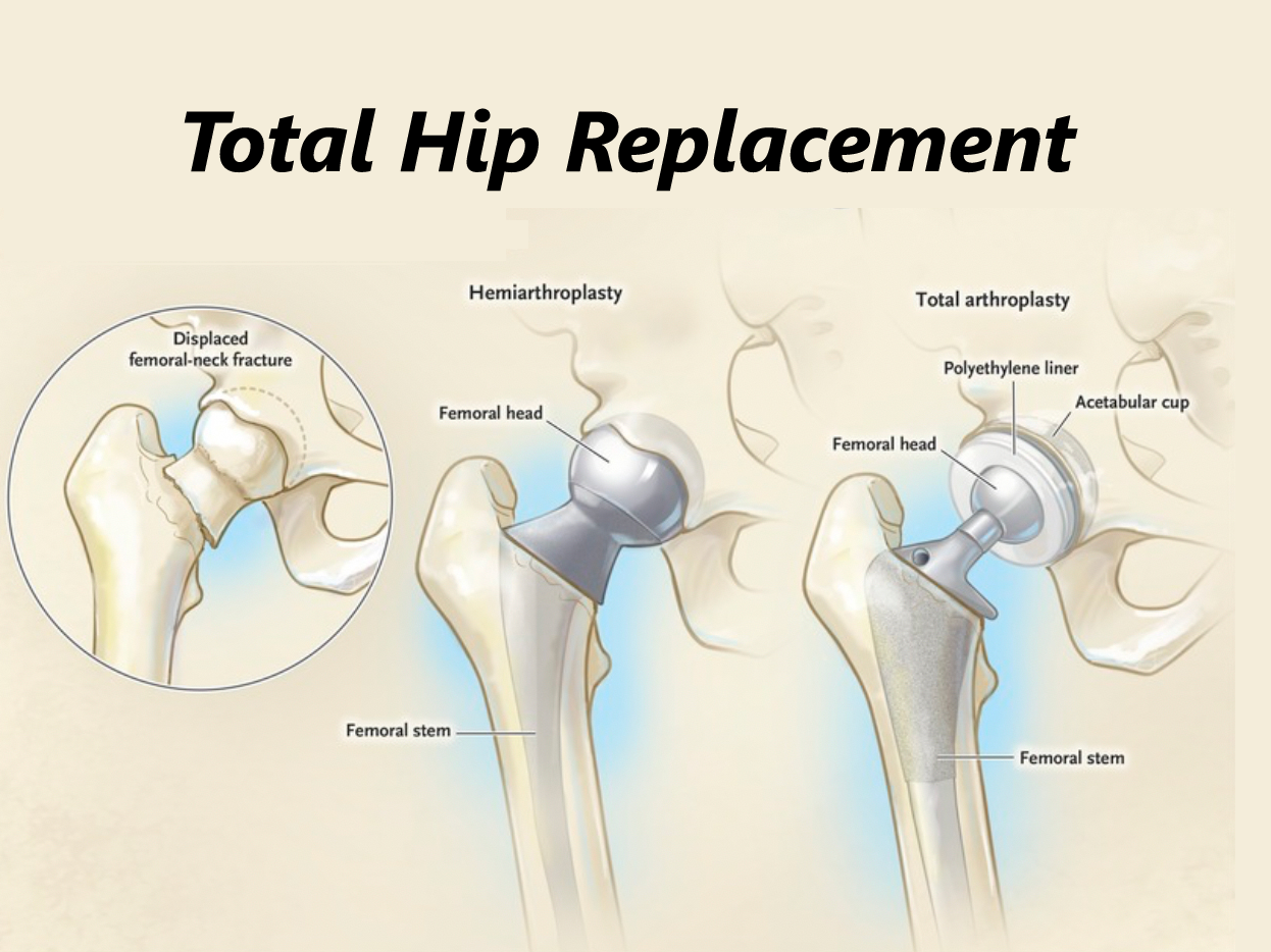 Total Hip Replacement