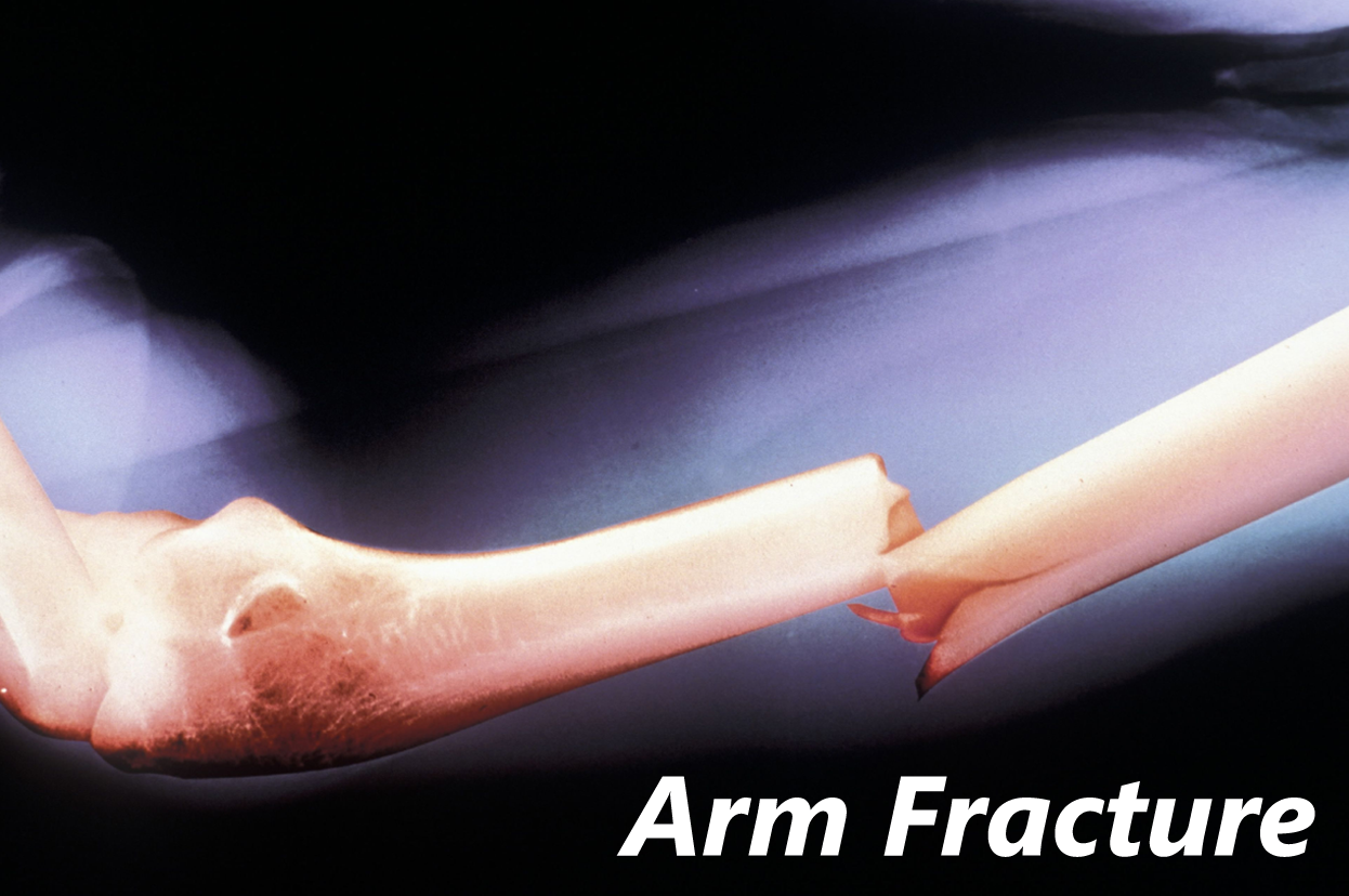 Arm Fracture