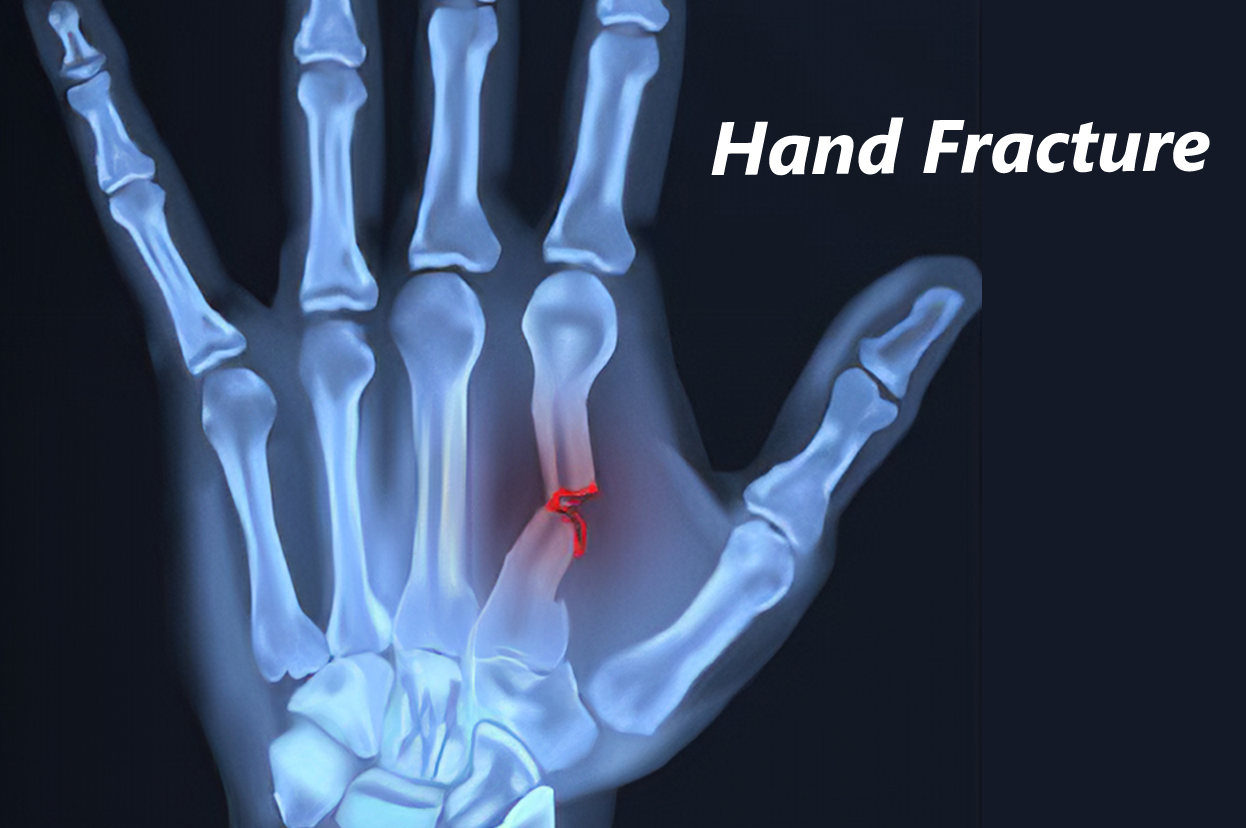 Hand Fracture