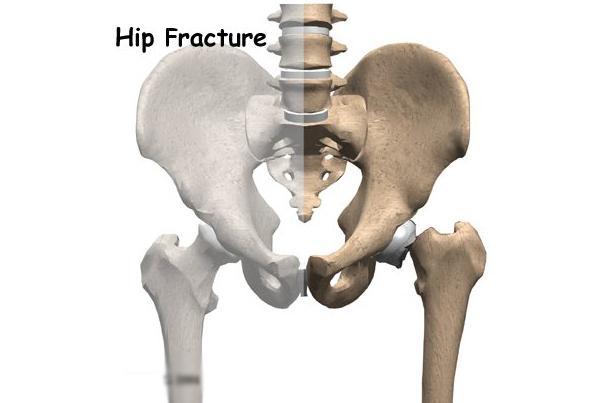 Hip Fracture