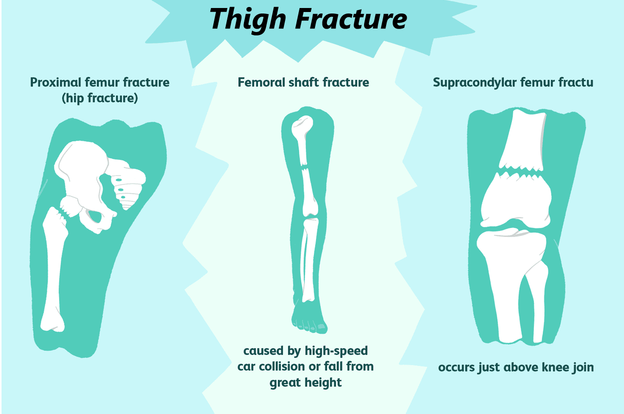 Thigh Fracture
