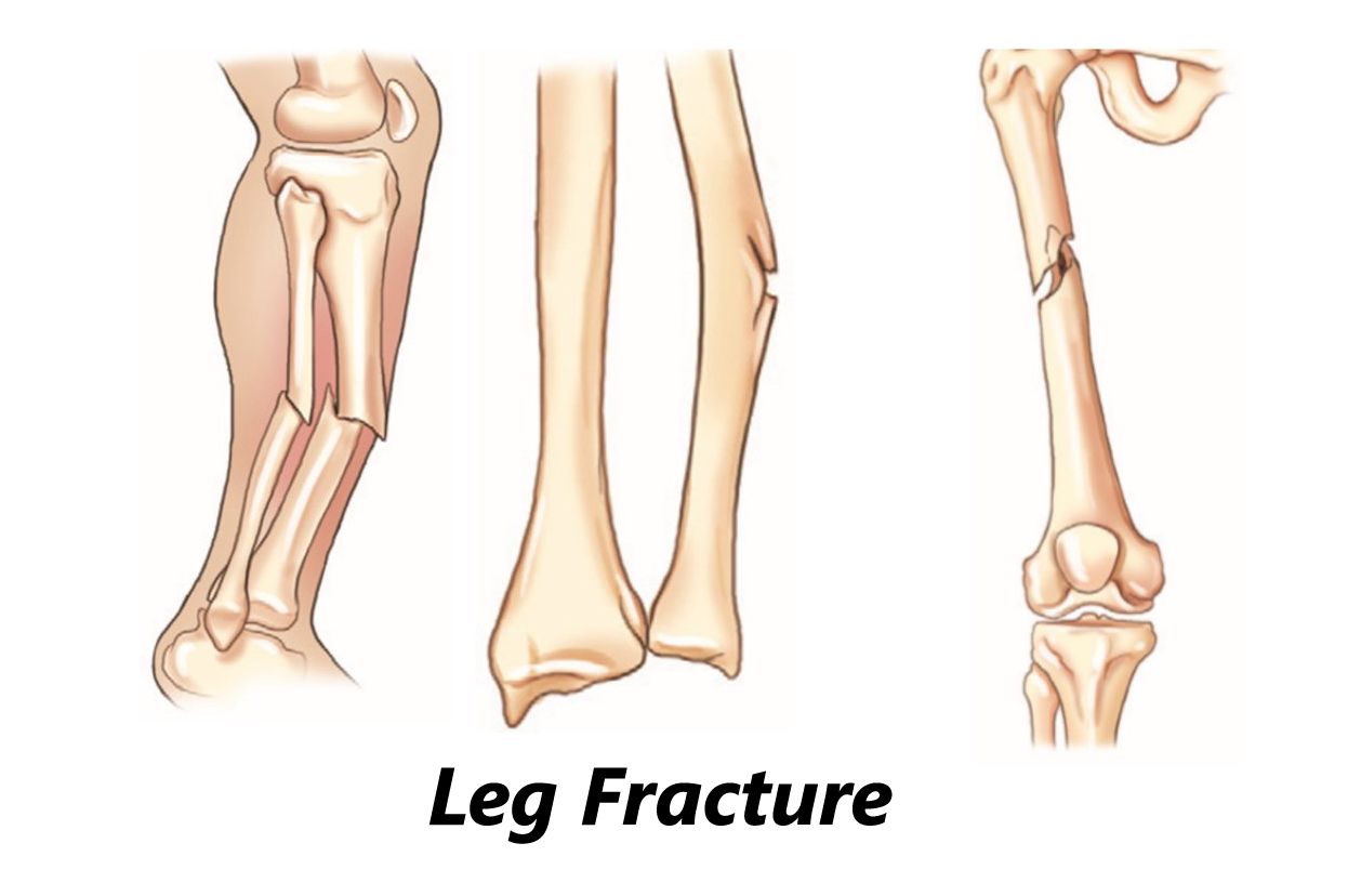 Leg Fracture